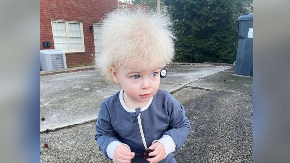 A little boy with uncombable hair syndrome